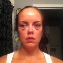 Goodnight, Day 1!  Looking better already (about 14 hours after surgery).