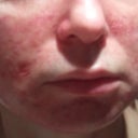 Day 1 after ePrime procedure