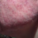 Day 1 after ePrime procedure(left cheek)