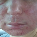 Day 4 after ePrime procedure