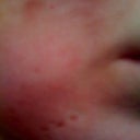 Day 36 after ePrime procedure