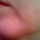 Day 36 after ePrime procedure