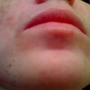 Day 55 after ePrime procedure