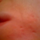 Day 55 after ePrime procedure