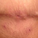 7wks PO and it looks so much better!