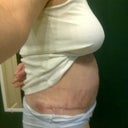 3 Week Post OP Side View