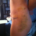 side view, lots of bruising where flanks were lipo'd.