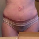 19 DPO...it's early but I think the scar will smooth out well :-) my belly button makes me laugh but I'll give it time