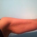 Left arm pre-op