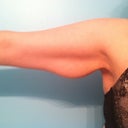 Right arm pre-op