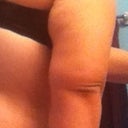 Right back side pre-op