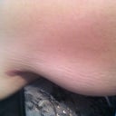 Right arm pre-op
