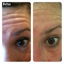 Before and after forehead