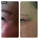 Before and after crows feet
