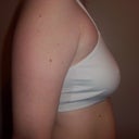 Pre-op right view