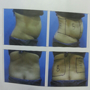 Day 0 - Before surgery. Marking of target area. (Photo from file)
