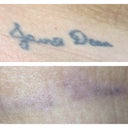 5 weeks after 6th treatment compared to before photos