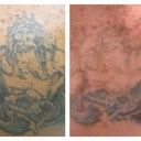 5 weeks after 6th treatment compared to before photos