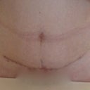2 1/2 weeks PO- staples are gone.  Scar scab is starting to peel off.  It itches.....
