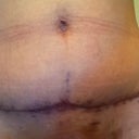 2 1/2 weeks PO- A closer shot of the incision.  The dark line is the scab which is starting to peel.