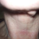 MY 6 month lump.. soon to be gone  I will add my 6 month shot in a minute