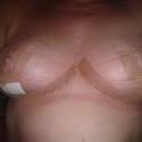 week 6 small opening on right boob but healing up