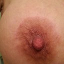 9 weeks incision from crescent lift