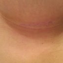 9 weeks under breast incision