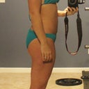 2 weeks post smartlipo