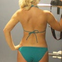 2 weeks post smartlipo