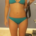 2 weeks post smartlipo