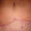 11 weeks PO! Close up of scar.  Fading nicely, crooked though it is.