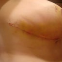Close ups, 11 days post op