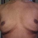 Now after implant removal for over a year.  Still pretty big.