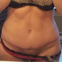 incision 7+ months