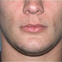 Before/After Genioplasty (Chin Surgery)