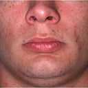 Before/After Genioplasty (Chin Surgery)