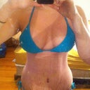 12 DAYS POST OP