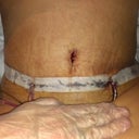First time seeing my new belly... Drains still in... But it's flat... :)