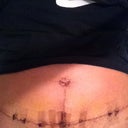 Belly button and incision 12 days PO