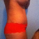 16 days post op