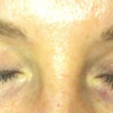 Before Latisse