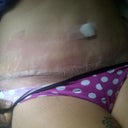 1 Week post op!!! All drains and tapes are gone!!  My incision looks great although you cant see it with the little tape