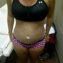 1 week post op.  redness is from the removal of the tape
