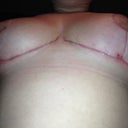 under at 8 weeks, everything is healed up nicely and love the shape