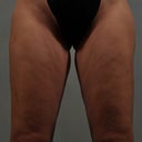 Front side of legs BEFORE