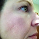 2 weeks post-fraxel #2. I am really, really hoping that as my skin heals this gets better - because it has seemed worse than when I started the past couple of days.