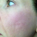 2 weeks post-fraxel #2. I am really, really hoping that as my skin heals this gets better - because it has seemed worse than when I started the past couple of days.
