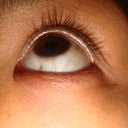 Day 1 Latisse