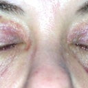 Day 9 upper eyelid suture lines. I am not real happy with the way they look. I hope they will heal to a thinner and flatter line